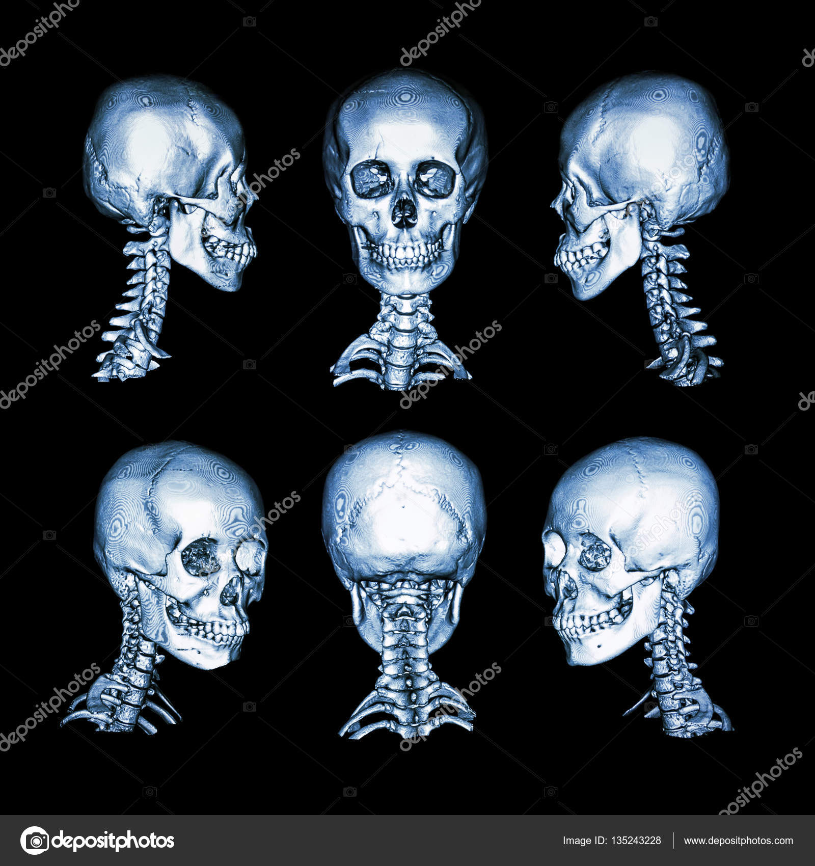 Numérisation CT et image 3D. Crâne humain normal et colonne cervicale