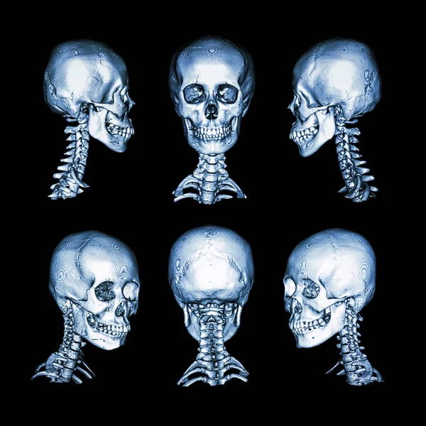 Tomografía computarizada e imagen 3D. Cráneo humano normal y columna cervical. todas las direcciones — Foto de Stock