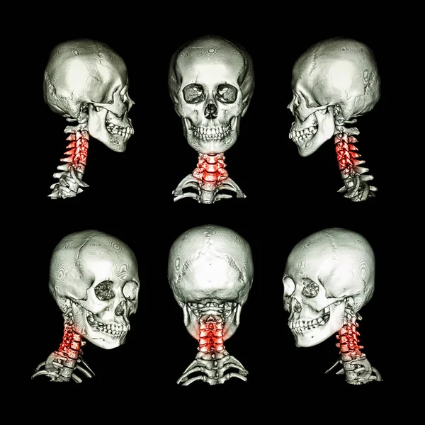 Tomografía computarizada e imagen 3D del cráneo y el cuello. Utilice esta imagen para la espondilosis cervical, espondilolistesis, espondilitis, condición de trauma de la columna vertebral  . — Foto de Stock