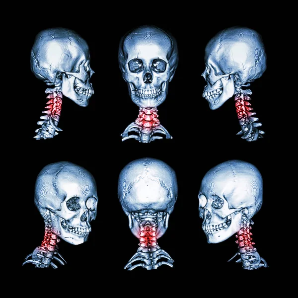 Tomografía computarizada e imagen 3D del cráneo y el cuello. Utilice esta imagen para la espondilosis cervical, espondilolistesis, espondilitis, condición de trauma de la columna vertebral  . — Foto de Stock