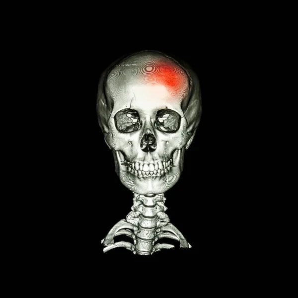 Un derrame. Tomografía computarizada con imagen 3D del cráneo humano y la columna cervical. vista anterior-posterior (AP)  ) . — Foto de Stock