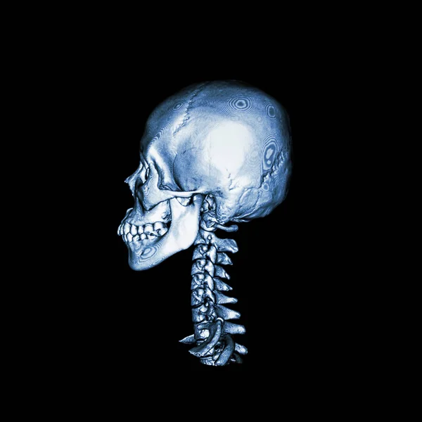 Tomografía computarizada con imagen 3D del cráneo humano normal y la columna cervical. vista lateral  . — Foto de Stock