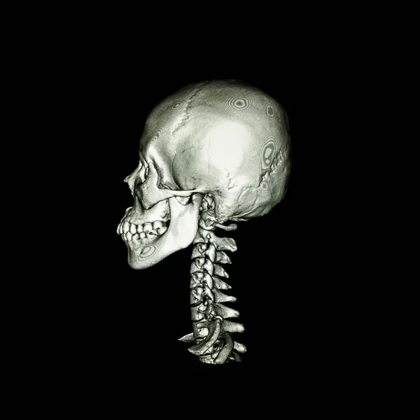 КТ с трехмерным изображением нормального человеческого черепа и шейного отдела позвоночника. боковой обзор  . — стоковое фото