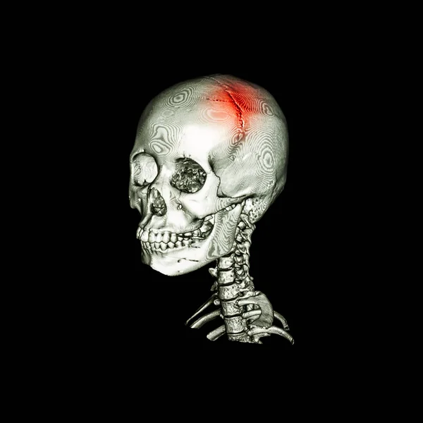 Un derrame. Tomografía computarizada con imagen 3D del cráneo humano y la columna cervical. vista oblicua  . — Foto de Stock