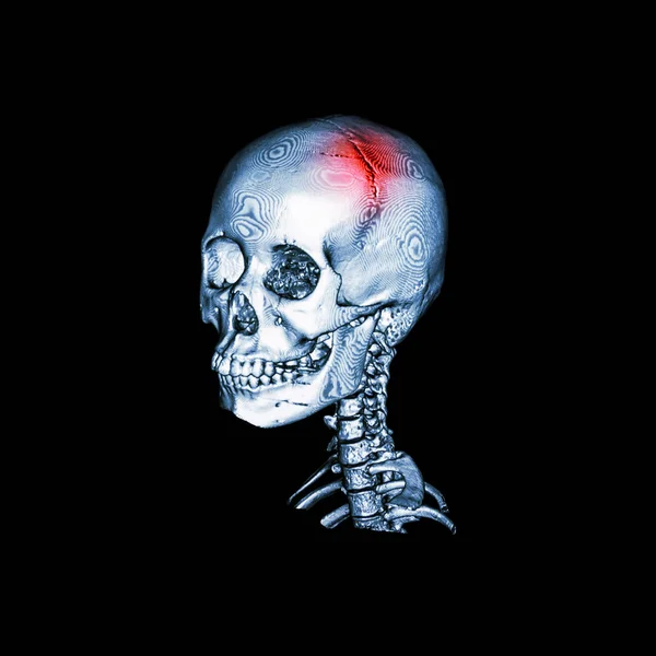 Traço. Tomografia computadorizada com imagem 3D de crânio humano e coluna cervical. vista oblíqua  . — Fotografia de Stock