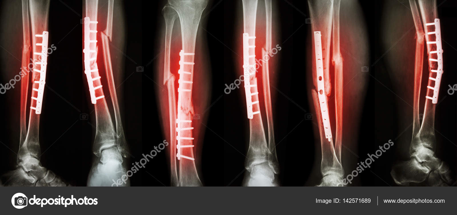 Collection image de fracture de jambe et traitement chirurgical ...