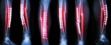Koleksiyon görüntü bacak kırığı ve plaka ve vida ile internal fiksasyon ile cerrahi tedavi. Tibia ve fibula kemiği kırmak .
