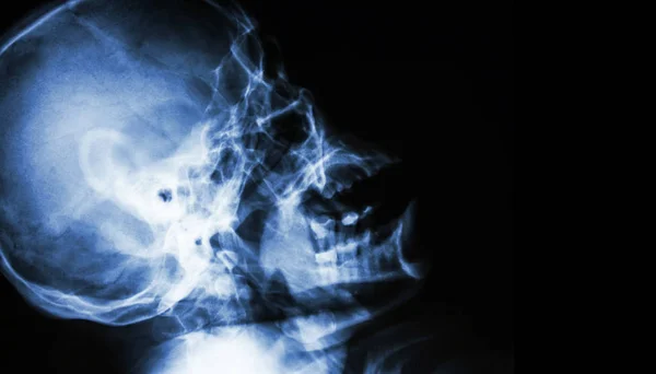 Film x-ışını normal insan kafatası. yan görünümü. sağ yan tarafta boş alan . — Stok fotoğraf