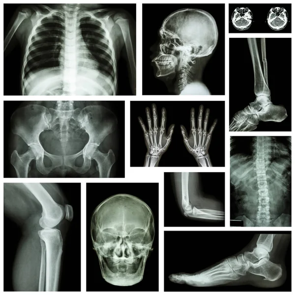 Набор рентгеновских снимков множественной части человека. Скелетная система  . — стоковое фото