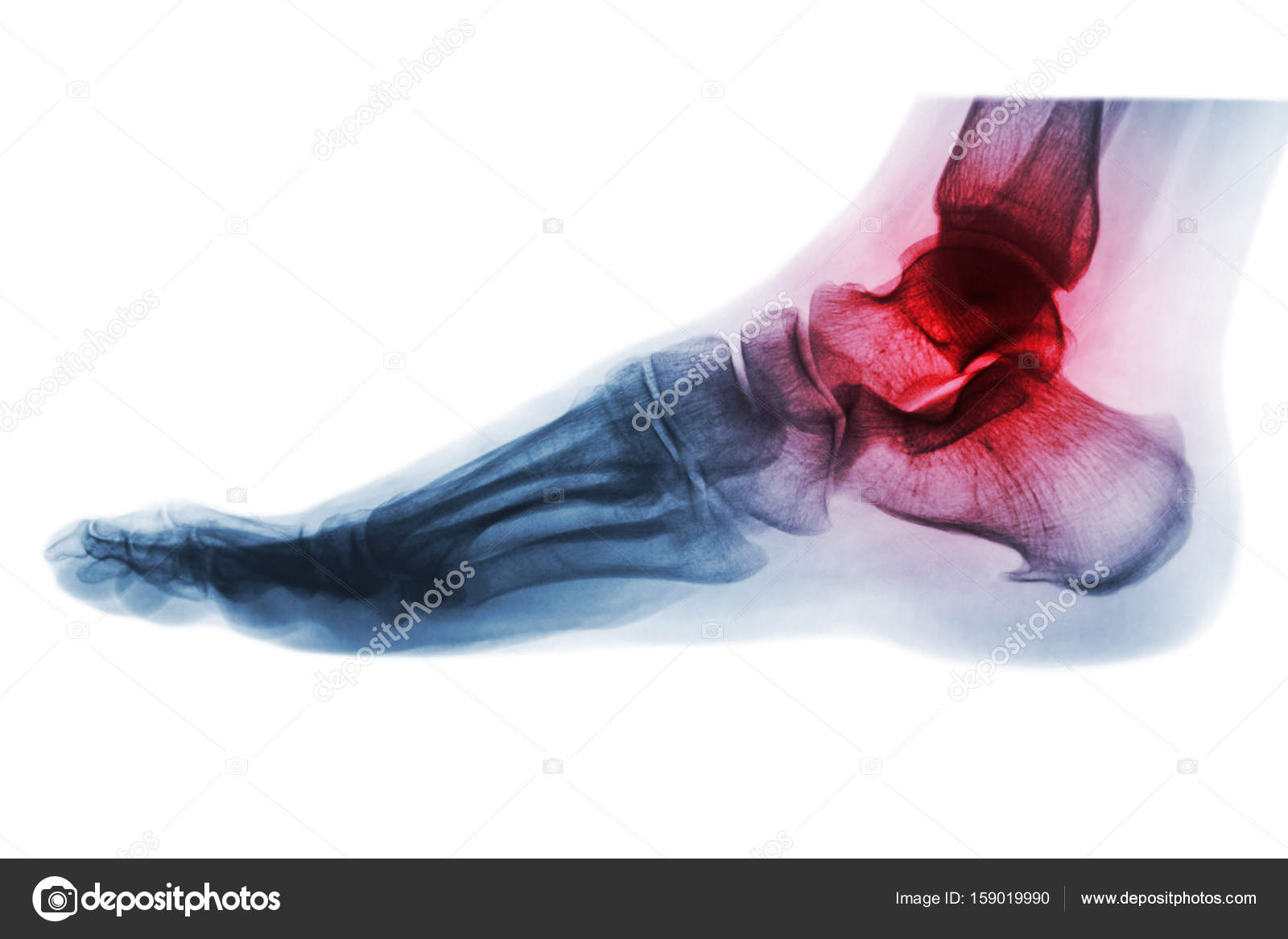 Arthritis of ankle . Xray of foot . Lateral view . Invert color style