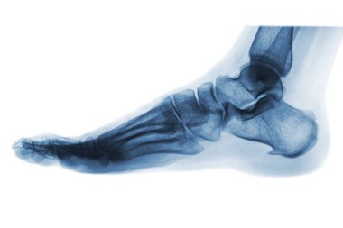 X-ray normal human foot . Lateral view . Invert color style . clipart