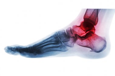 Arthritis of ankle . X-ray of foot . Lateral view . Invert color style . clipart
