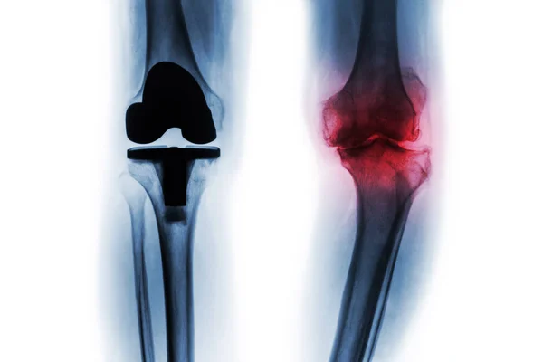 X 光胶片的膝关节骨性关节炎患者和人工关节 （全膝关节置换术）。孤立的背景 . — 图库照片