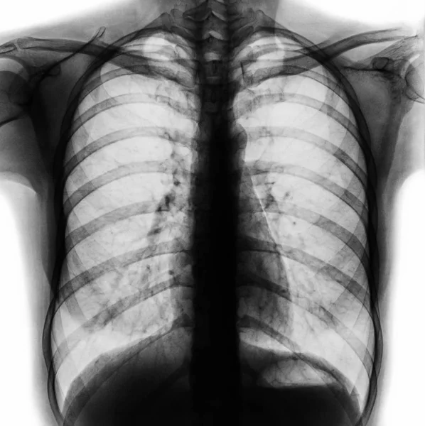 Film chest x-ray PA upright show normal human chest . — Stock Photo, Image
