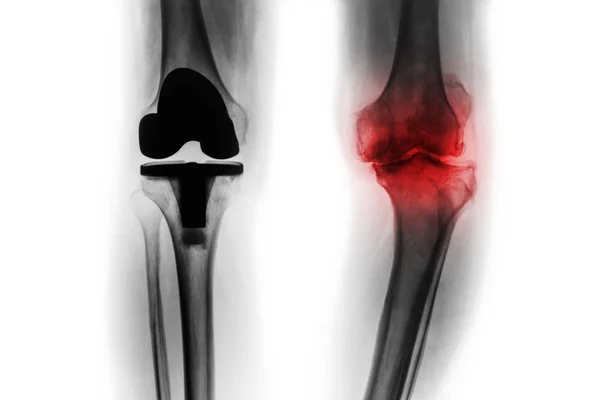 Radiografia de filme de paciente osteoartrite joelho e articulação artificial (substituição total do joelho). Fundo isolado  . — Fotografia de Stock