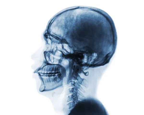 Raggi X cranio normale e colonna vertebrale cervicale. Vista laterale. Inverti lo stile colore  . — Foto Stock