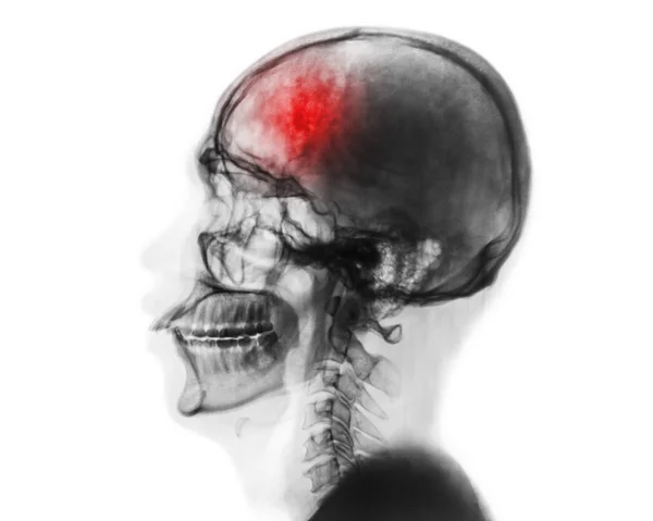 Un derrame. Accidente cerebrovascular. Radiografía de película de cráneo humano y columna cervical  . — Foto de Stock