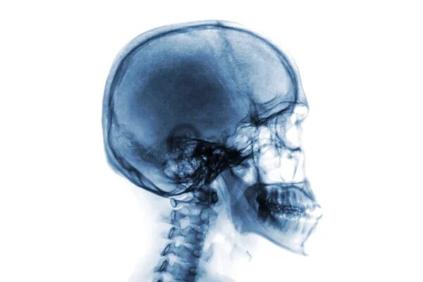 Rayos X cráneo normal y columna cervical. Vista lateral. Invertir el estilo de color  . — Foto de Stock