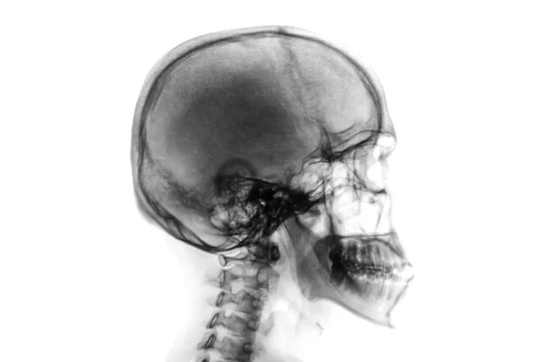 Raio-X crânio normal e coluna cervical. Vista lateral. Inverter estilo de cor  . — Fotografia de Stock