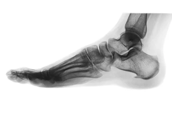 Raios-X, pé humano normal. Vista lateral. Inverter estilo de cor  . — Fotografia de Stock