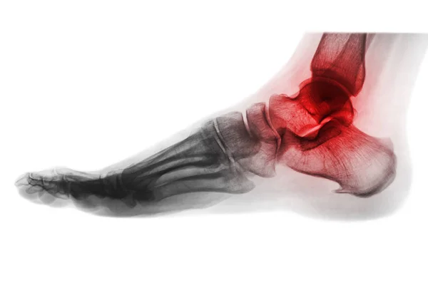 Arthritis pergelangan kaki. X-ray kaki. Pemandangan Lateral. Balik gaya warna  . — Stok Foto