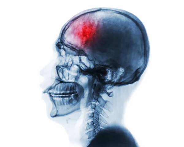 脑卒。脑血管意外。人类的头颅骨及颈椎 x 光胶片 . — 图库照片