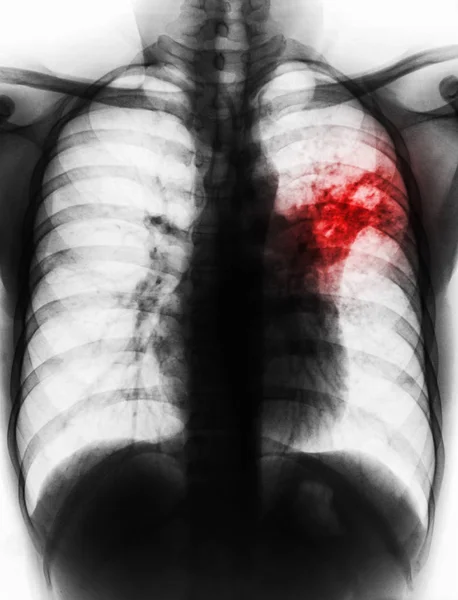 Tuberculosis pulmonar. La radiografía de tórax muestra infiltrado alveolar en el pulmón medio izquierdo debido a la infección por Mycobacterium tuberculosis  . — Foto de Stock