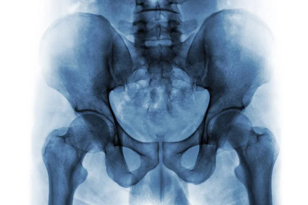 Film x-ray of normal human pelvis and hip joints . — Stock Photo, Image