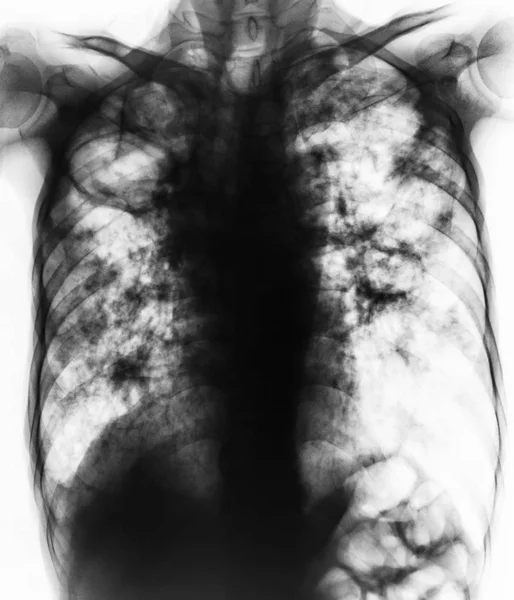 Tuberkulosis pulmoner. Film dada x-ray menunjukkan fibrosis, rongga, infiltrasi interstisial kedua paru-paru karena infeksi Mycobacterium tuberculosis  . — Stok Foto