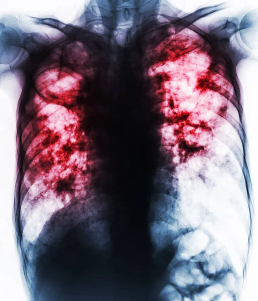 Pulmonary Tuberculosis . Film chest x-ray show fibrosis,cavity,interstitial infiltration both lung due to Mycobacterium tuberculosis infection . — Stock Photo, Image