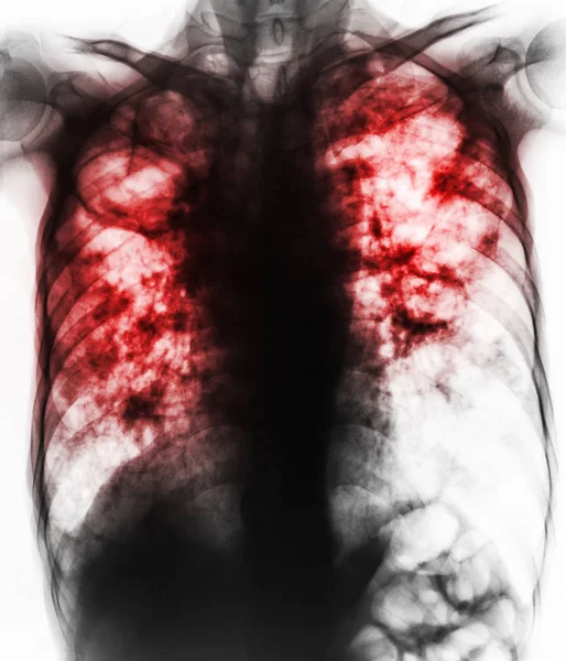 肺結核。胸部 x 線フィルムの線維化、空洞、間質浸潤を示す結核菌感染による両方の肺 . — ストック写真