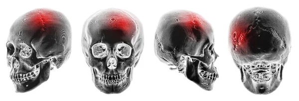 Un derrame. Accidente cerebrovascular. Tomografía computarizada 3D del cráneo humano. Vista múltiple. Invertir el estilo de color  . — Foto de Stock