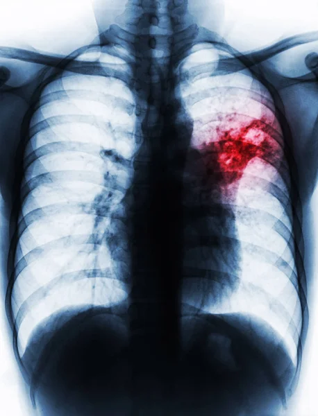 Lungentuberkulose. Röntgenbild der Filmbrust zeigt Alveolarinfiltrat in der linken mittleren Lunge aufgrund einer Mykobakterium-Tuberkulose-Infektion . — Stockfoto