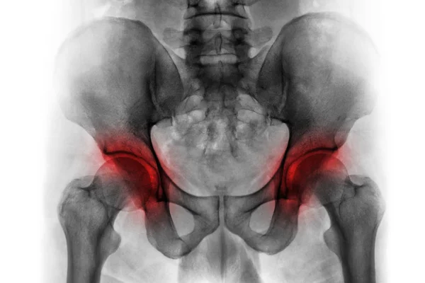 Artrit båda HipHop. Film röntgenbild av mänskliga bäckenet . — Stockfoto