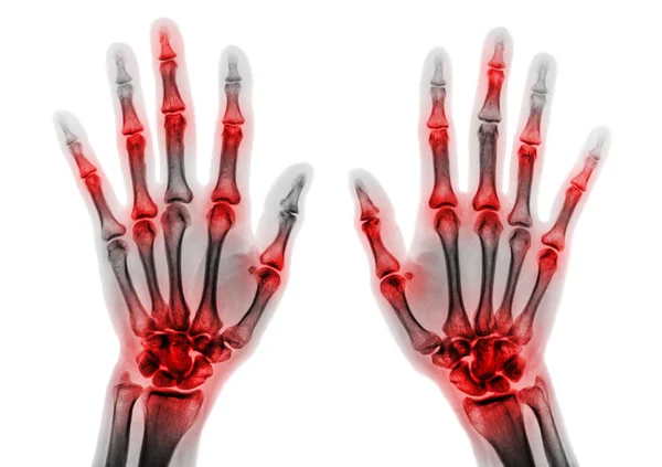 Artrite articolazione multipla delle dita. Film radiografia delle mani e dei polsi  . — Foto Stock