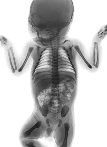 Película de rayos X todo el cuerpo de un bebé normal. vista frontal  . — Foto de Stock