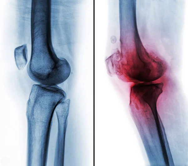 Srovnání mezi normální lidské koleno (obrázek vlevo) a osteoartrózy kolene (obrázek vpravo). Boční pohled — Stock fotografie