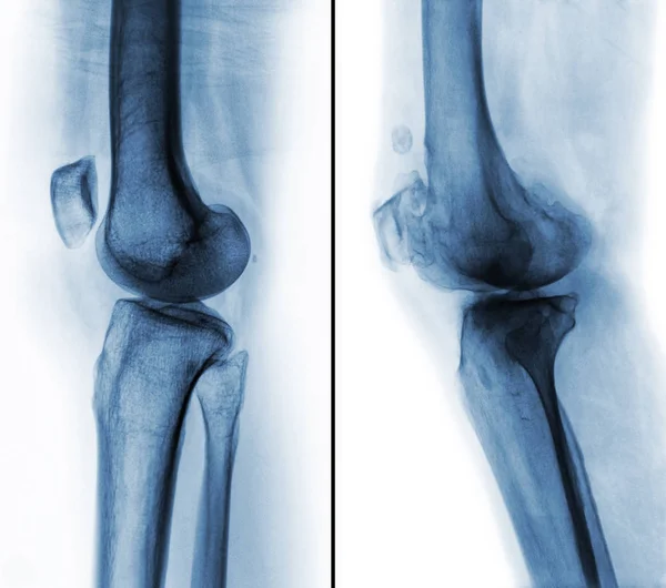 Comparação entre joelho humano normal (imagem à esquerda) e osteoartrite (imagem à direita). Vista lateral — Fotografia de Stock