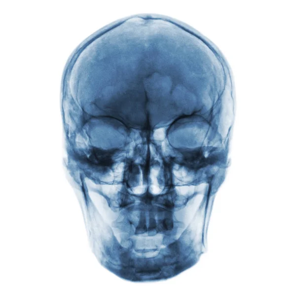 Film x-ray van normale menselijke schedel. Vooraanzicht — Stockfoto