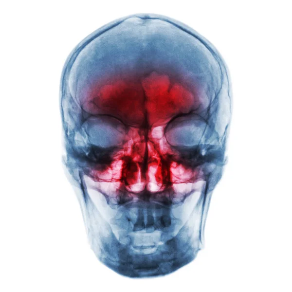 Sinusitis. Radiografía de película del cráneo humano con inflamación en los senos paranasales — Foto de Stock