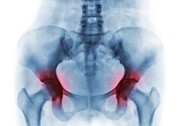 Artritis en ambas caderas. Radiografía de película de pelvis humana — Foto de Stock