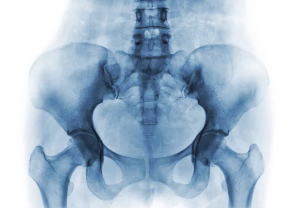 人体正常骨盆和髋关节的 x 光胶片 — 图库照片