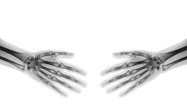 Potřást rukou. X-ray normální lidské ruce — Stock fotografie