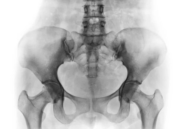 Film x-ray van normale menselijke bekken en heupgewrichten — Stockfoto