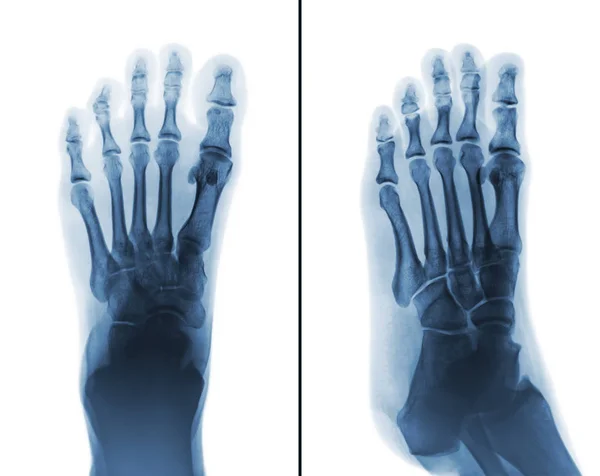 Her iki normal insan ayağı film x-ışını . — Stok fotoğraf
