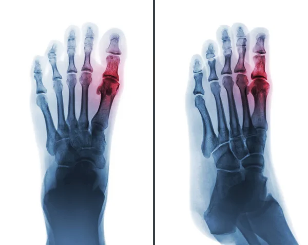 Giktartrit. film röntgenbild av mänsklig fot och artrit vid första metatarsofalangeala leden . — Stockfoto