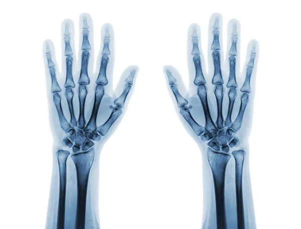 Fluorografy stacjonarne zarówno normalnych ludzkich rąk. Widok z przodu — Zdjęcie stockowe