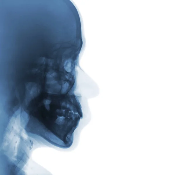 Рентген нормального человеческого черепа. боковой обзор  . — стоковое фото