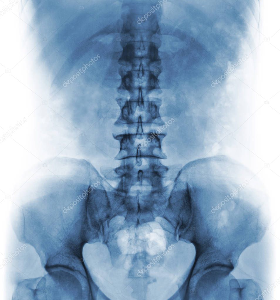 Film x-ray of normal human lumbar spine .