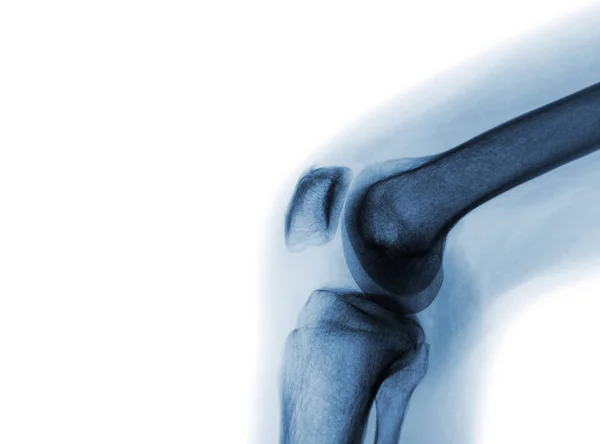 Film x-ray van normale kniegewricht — Stockfoto